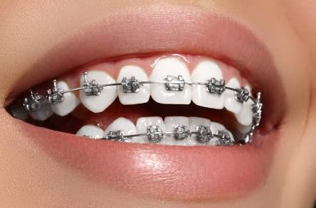 Orthodontic metal braces