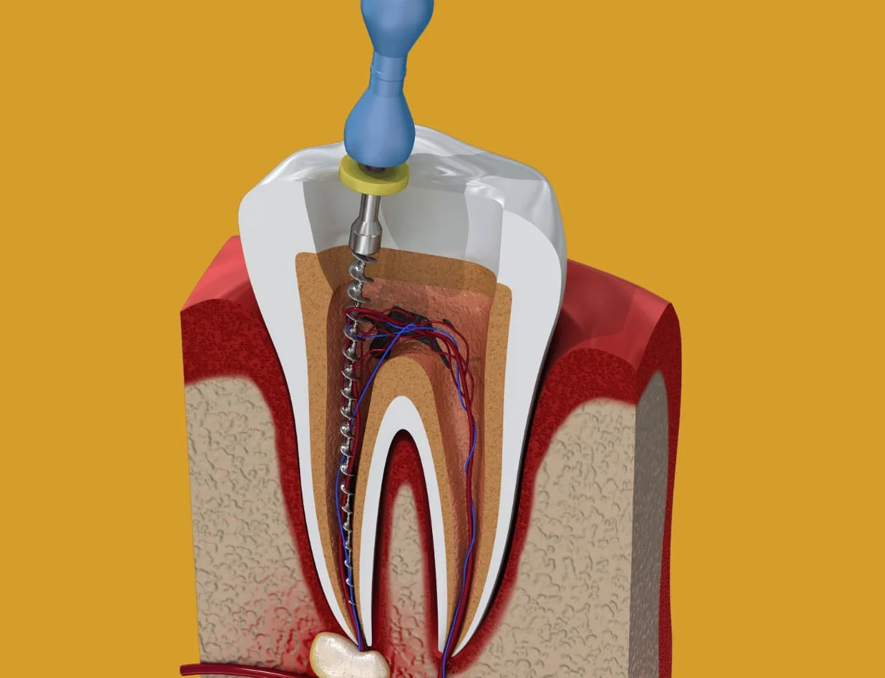 Root Canals