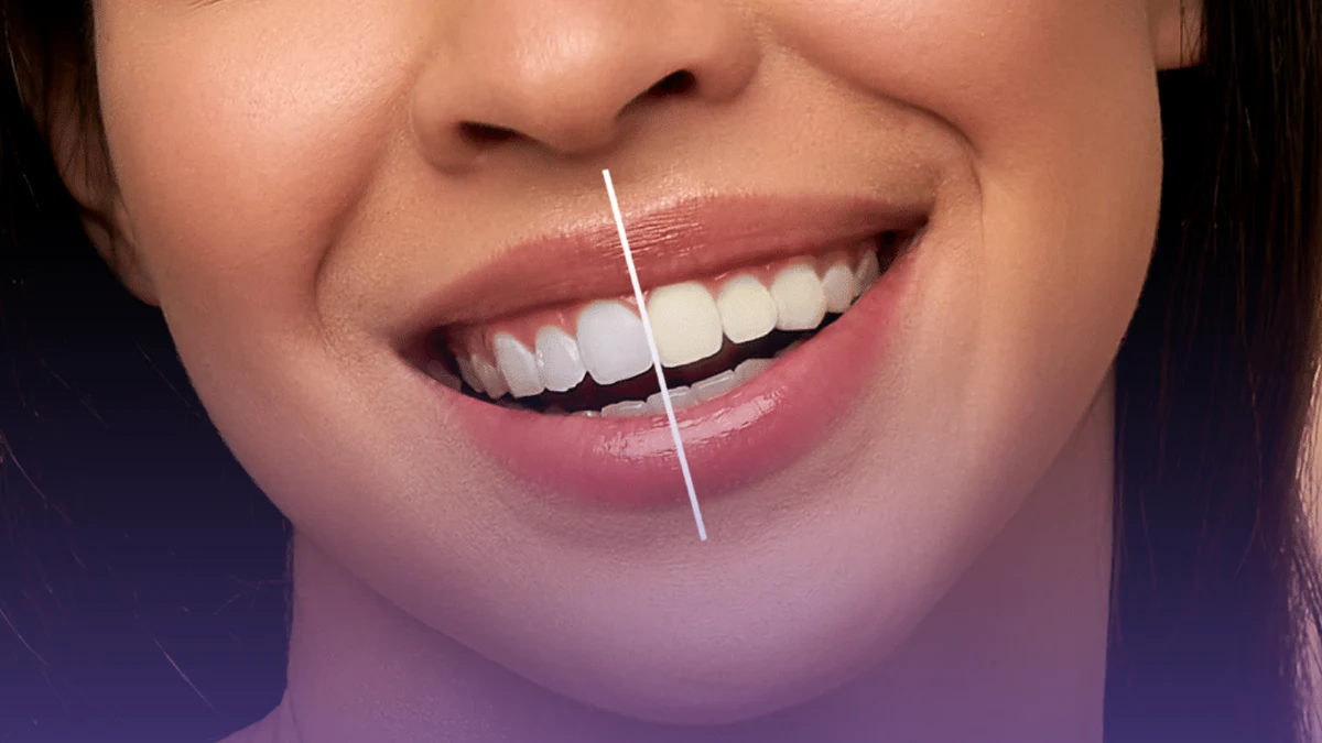 Teeth Whitening
