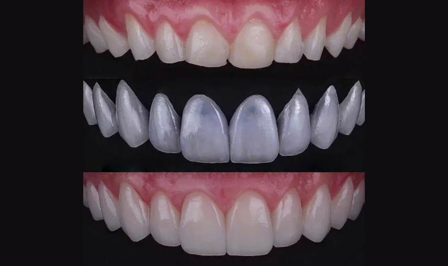 Veneers & Crowns